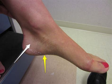 signs of heel stress fracture